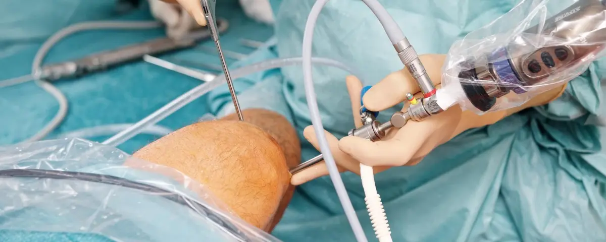 Eine arthroskopische Kniebehandlung Diagnose und Therapie eines Kreuzbandsch&auml;den